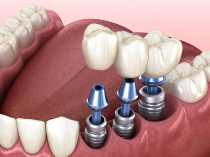 illustration of dental implant parts being assembled into mouth with natural teeth, dental implants Washington DC